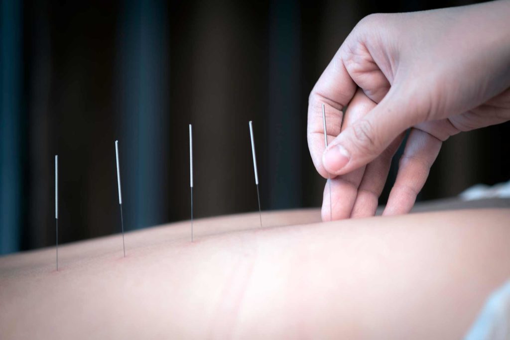 Acupuncture - Medwell